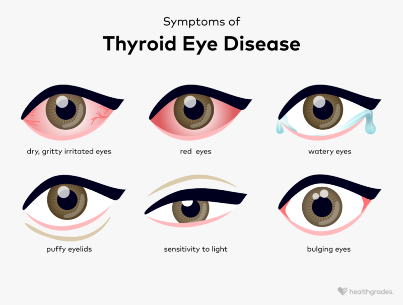 Unveiling Thyroid Eye Disease: Understanding and Managing Symptoms